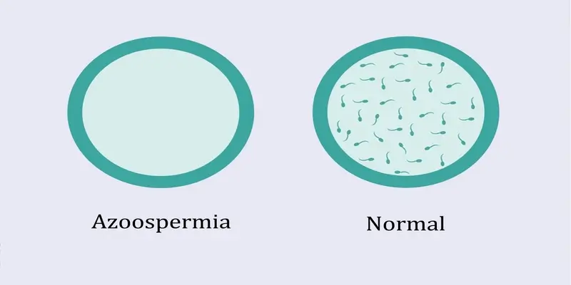 Azoospermia Treatment