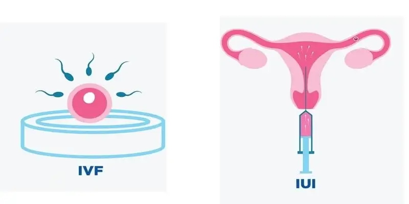 What Is The Difference Between IUI And IVF?