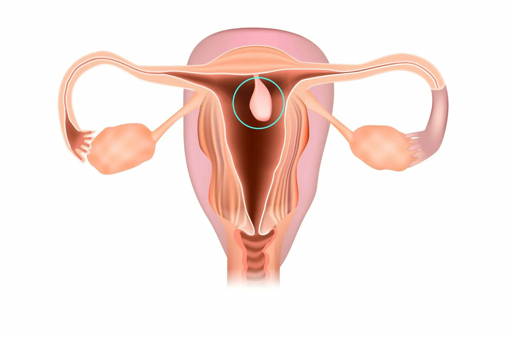 Uterine Polyps And Miscarriages