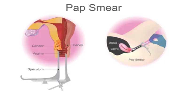 Pap smear 中文